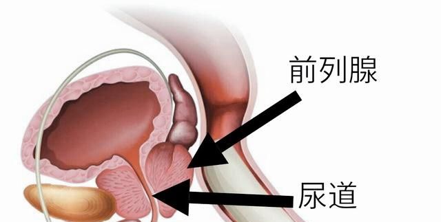 前列腺4.3*3.2*3.1正常吗图2