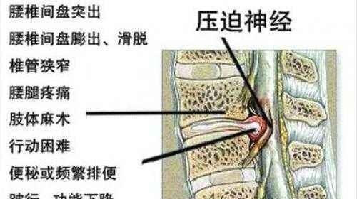 27岁男生得了腰间盘突出加轻微骨质增生，很少有放射性疼痛，但是长期腰酸背痛，怎么办图3