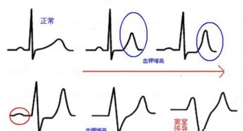 高钾血症如何降钾图3