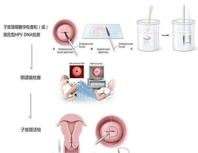 hpv3353阳性,tct正常图3