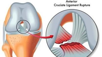 十字韧带，怎样预防十字韧带损伤图1